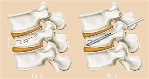 Physical Therapy after Kyphoplasty Can Heal You Faster | Young Kennel