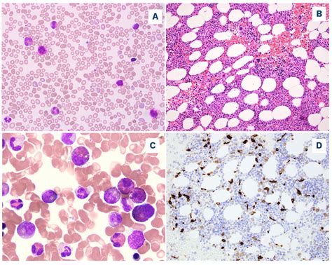 Stat B Mutations In Myeloid Neoplasms Differ By Disease Subtypes But