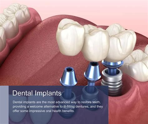 Dental Implants In Manhattan And Brooklyn Ny Top Rated Implant Dentist