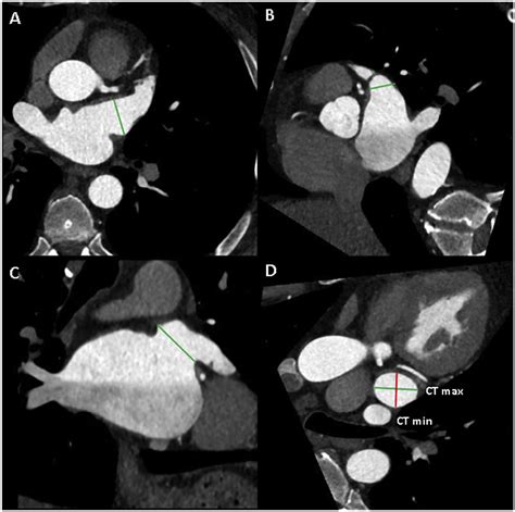 Computed Tomography Measurement Of The Left Atrial Appendage For