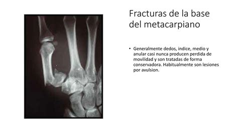 Clasificación diagnostico manejo quirúrgico fractura metacarpos PPT