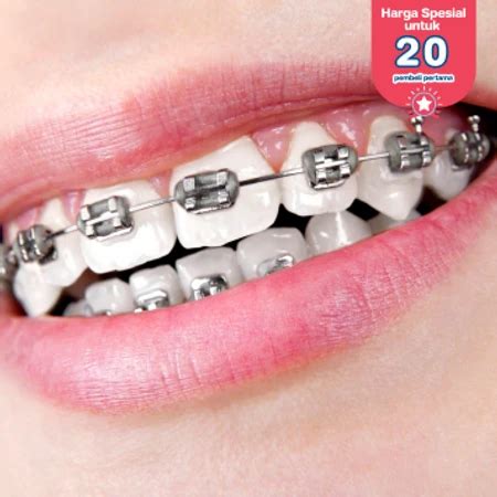 Pasang Behel Metal Di Infinity Dental Studio Hdmall