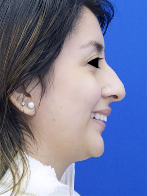 Cases In Rhinoplasty External Mao Facial Plastics