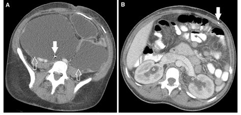 Axial Ct Images Through The Abdomen And Pelvis Of A Patient With Vp