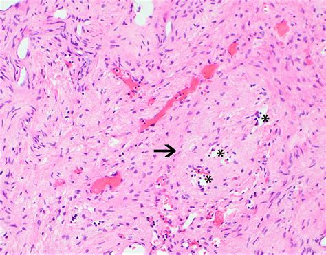 Hemangioma Histology