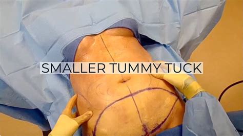 Full tummy tuck belly button - tasteconstruction