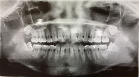 Impacted Wisdom Tooth Horizontal