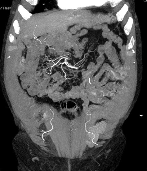 Diverticular Bleed Descending Colon Colon Case Studies Ctisus Ct