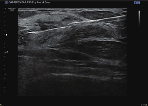 Ultrasound Guided Core Needle Biopsy Procedure 2d Ultrasound Image Download Scientific Diagram