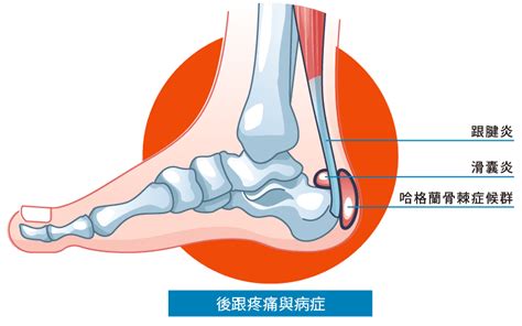 腳跟痛跟腱炎多久會好 維力骨科診所