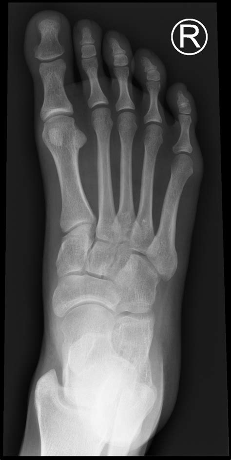 Normal Foot X Rays Image