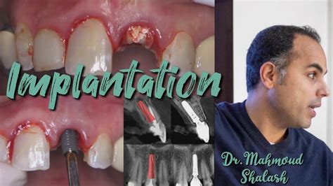 Dental Implantation Soft Tissue Augmentation Around Dental Implants