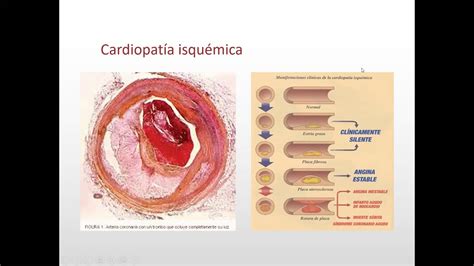 Cardiopatia Isquemica Youtube