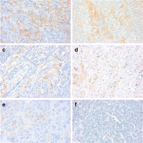 Immunoreactivity Of PD L1 PD L1 Expression In 50 A 25 And