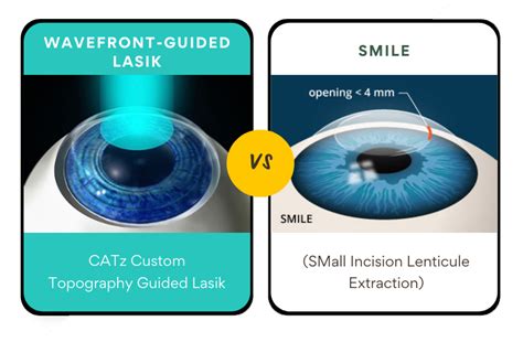 Smile Vs Lasik 2024 Aurore Constantine