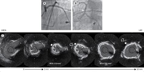 Intravascular Imaging In Coronary Artery Disease The Lancet