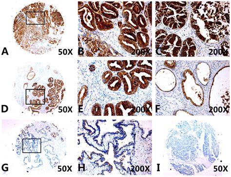 High C X C Motif Chemokine 5 Expression Is Associated With Malignant