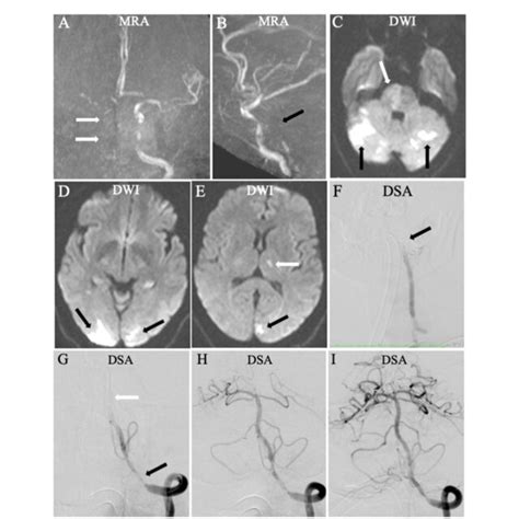 FIGURE Endovascular Treatment EVT For A Patient With Higher National