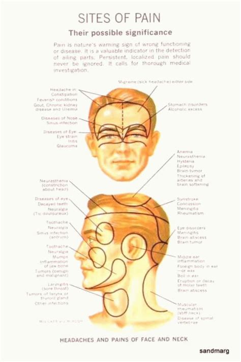 What locations of headaches mean. Decoding Headache Locations: Meanings ...