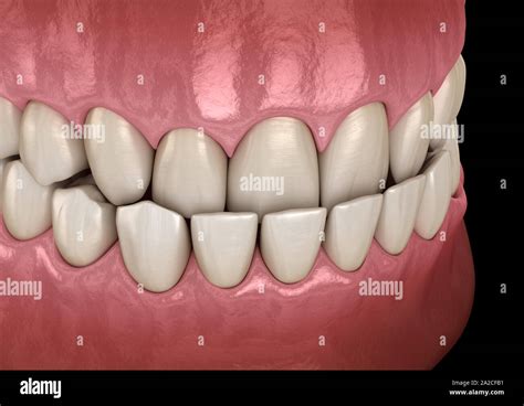 Underbite Dental Occlusion Malocclusion Of Teeth Medically