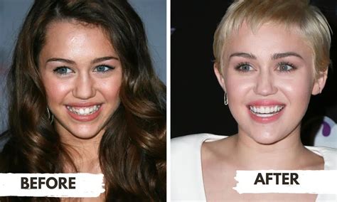 Miley Cyrus’ Teeth - Dentatur