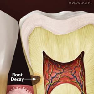 Watch For Root Cavities As You Age CenterCare Dental Group