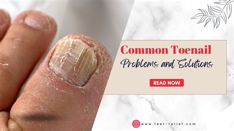 Common Toenail Problems and Solutions - Feet Relief