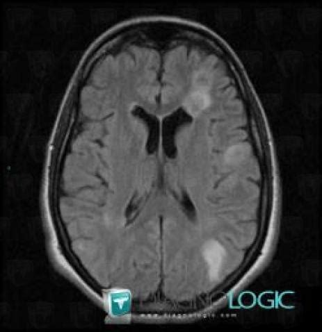 Cas Radiologie M Tastase Scanner Irm Diagnologic