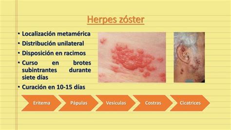 Herpes Z Ster Diseminado Ppt Descarga Gratuita