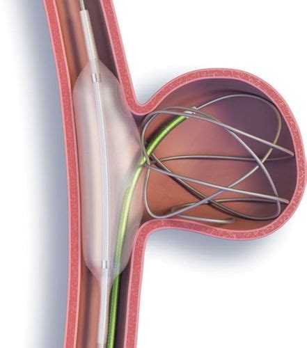 Endovascular Treatment Of Intracranial Aneurysms Stroke