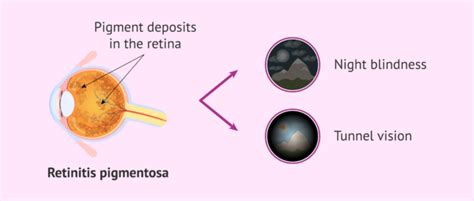 Vision with retinitis pigmentosa