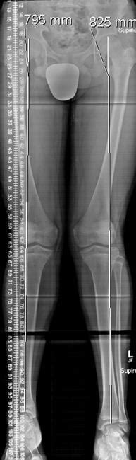 Lower Limb Length Discrepancy Orthoinfo Aaos