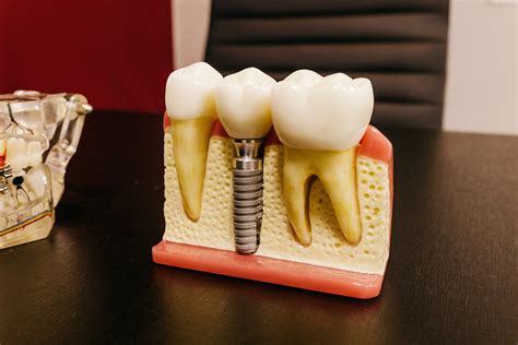 How Do Dental Implants Stay In Place