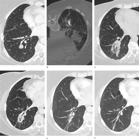 Lung Metastasis From A Primary Rectal Cancer In A 55 Year Old Woman Download Scientific