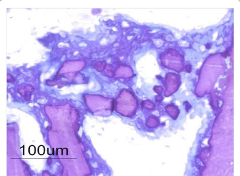 Formation and mineralization of osteoid matrix. It is visible the ...