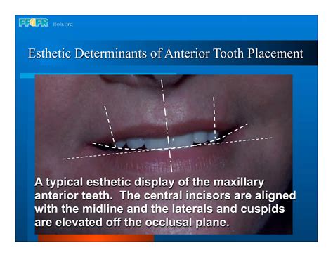 Complete Dentures 16occlusal Schemes Lingualized Occlusion Ppt