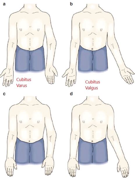 Physical Exam Elbow WikiSM Sports Medicine Wiki