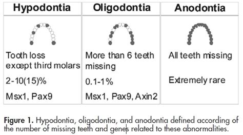 Oligodontia | Causes, Diagnosis and Treatments - Medicaregate