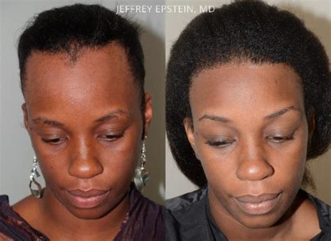 Forehead Reduction Surgery Photos Miami FL Patient37317