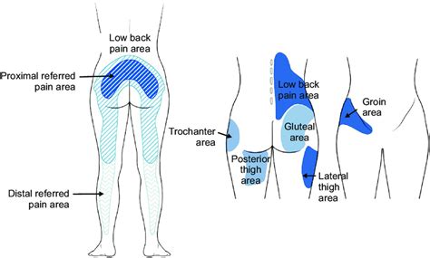 Illustration of distribution pattern related to facet joint pain ...