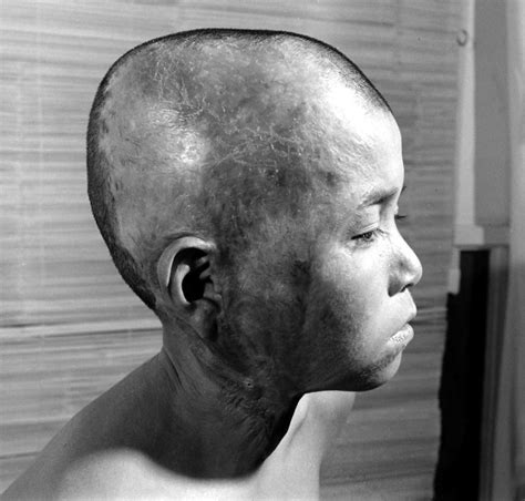 Hiroshima: Photos of Survivors of the World's First Atomic Attack