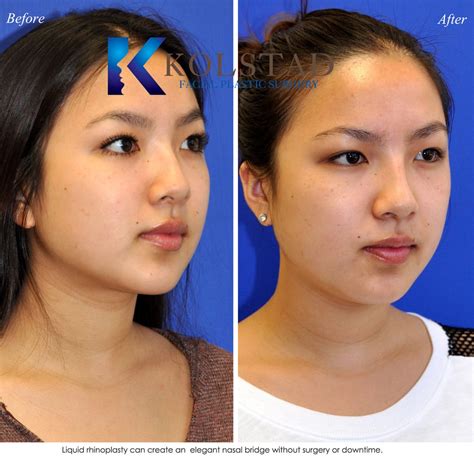 Asian Rhinoplasty Before And After