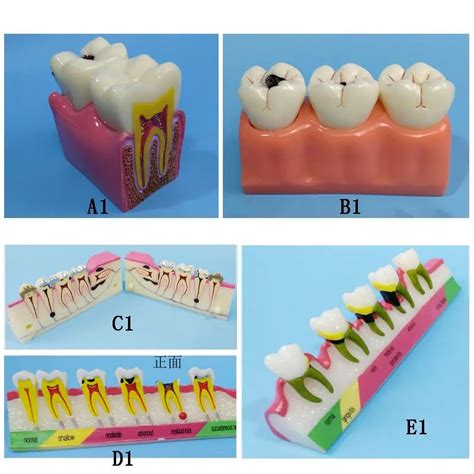 Dental Teaching Practice Tooth Model Type B Buy Dental Replaced Teeth