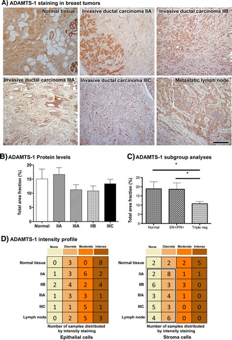 ADAMTS 1 Was More Abundant In Normal Tissue Stroma As Compared To Tumor