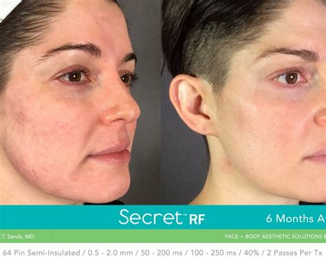 Secret Rf Radio Frequency Microneedling Image Perfect Laser