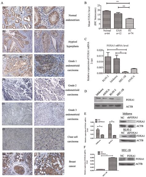 Overexpression Of Foxa1 In Normal Endometrium Endometrial Cancer Ec