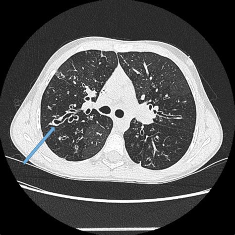 Radiology Bronchiectasis