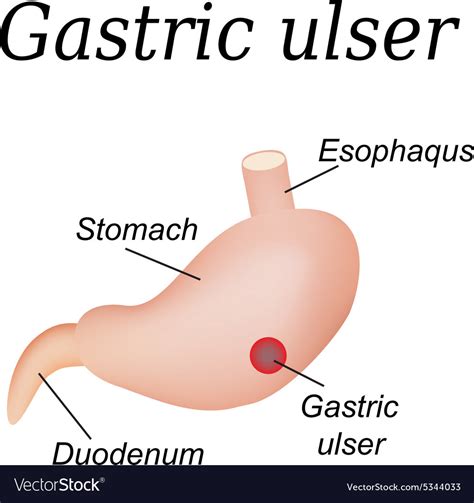 Stomach Ulcer Affected Gastric Ulcer Royalty Free Vector