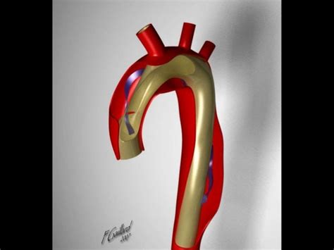 Complex Aortic Arch Surgery