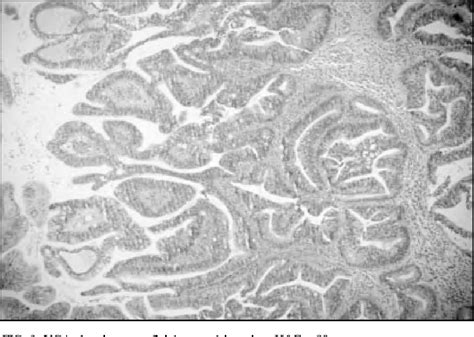 Figure 1 From Villoglandular Adenocarcinoma Of Cervix A Tumour With